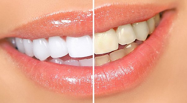 Busca a un profesional para blanquearte los dientes