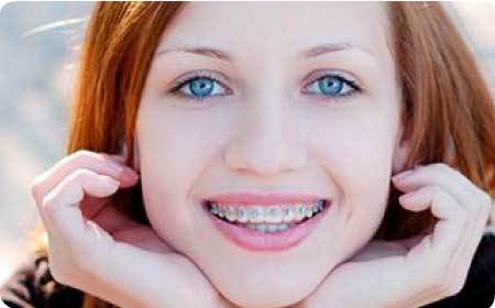 brackets-metalicos-Mardental.jpg